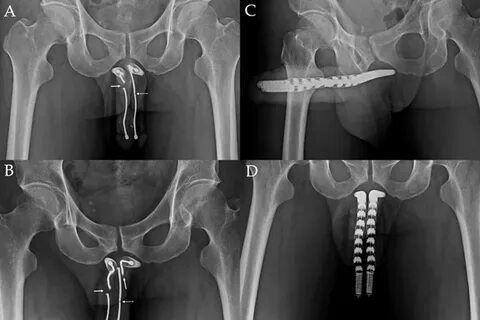 Penile Implantation Services Hsu`s Andrology