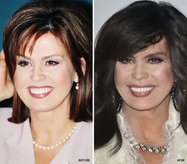 Marie Osmond Plastic Surgery