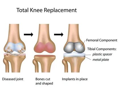 Stem cell treatments for arthritic knees are unproven, expen