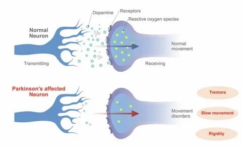 Parkinson's Disease Dopaminergic Neurons - Captions Update T