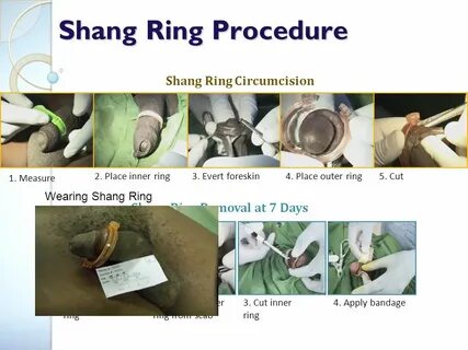 The Shang Ring vs Conventional Surgical Techniques: an RCT i