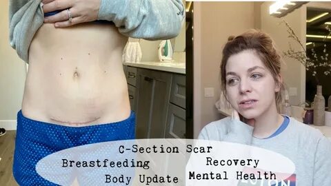 C Section Scar and Body Update - Four Month Postpartum - You