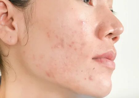 How is adult acne treated?