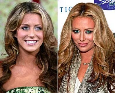 Aubrey O’Day Lip Augmentation Plastic Surgery Before and Aft