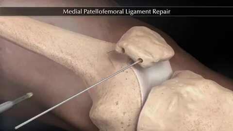 LCP - Reconstruction du MPFL Ligament Fémoro Patellaire Médi