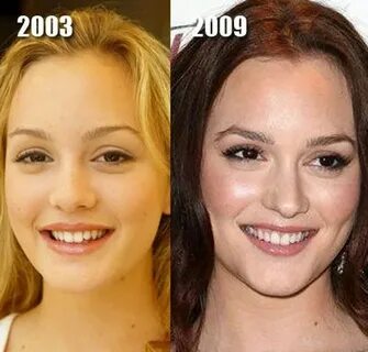 Wowza! All I can detect is a nose job, but what a difference