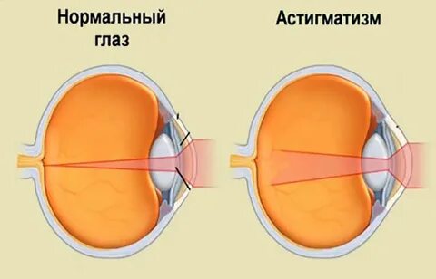 Астигматизм: степени, виды, лечение, коррекция, как выявить