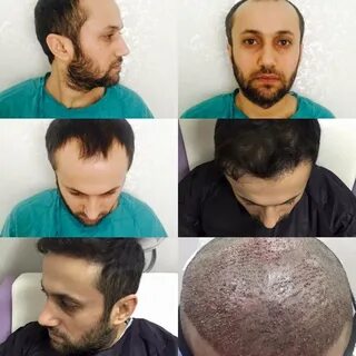 Пересадка волос в Турции и турецкий Дом-2 AnnY Яндекс Дзен