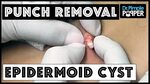 A Cyst Removed via Punch on a Wonderful Patient!
