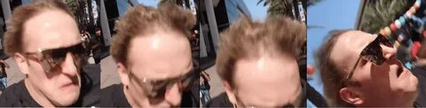 LOGAN PAUL Hair Loss and Balding - Top Hair Loss Treatments