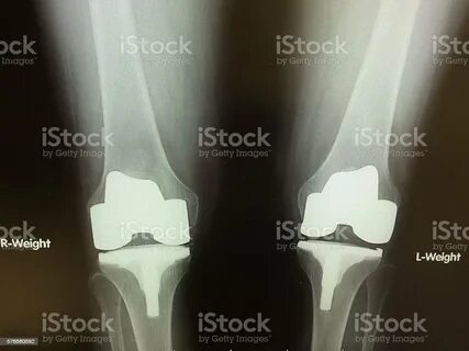 Knee Replacement Stock Photos, Pictures & Royalty-Free Image