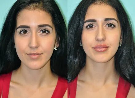 See? 37+ Facts About Permalip Lip Implants Before And After 