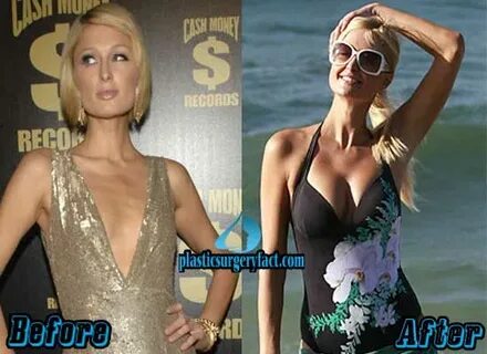 Paris Hilton Breast Implants: Fact or Rumor - Plastic Surger