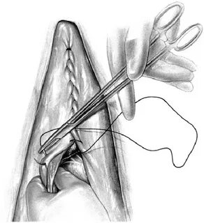 Continuation of the Utrecht suture pattern. Suture placement