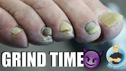 GRINDING DOWN THICK DAMAGED TOENAILS - YouTube