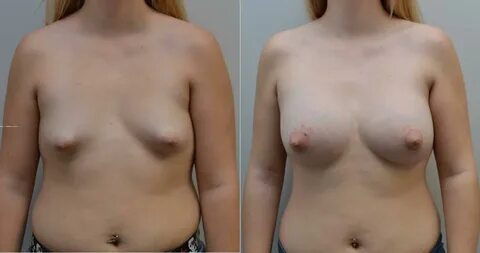 Droopy boobs plastic surgery before pictures