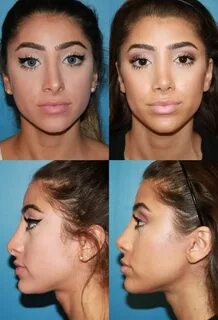 Are you searching for the best rhinoplasty surgeon in San Di