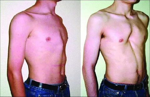 Adolescent boys with pectus carinatum (left) and pectus exca