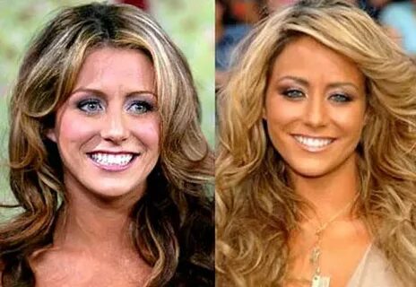 Aubrey O Day Plastic Surgery Before and After Plastic Surger