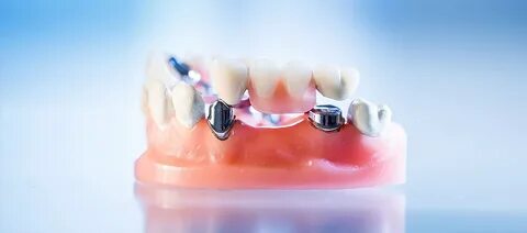 Herausnehmbarer Zahnersatz - flexibel und kostenbewusst