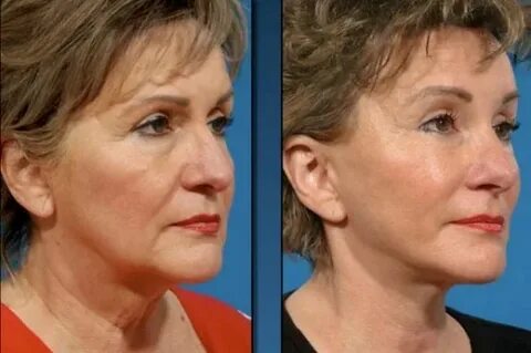 Joyce Meyer Plastic Surgery