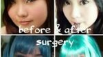 ALODIA GOSIENGFIAO BEFORE AND AFTER SURGERY PICTURES RETOKE 