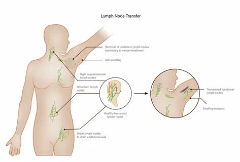 Can lymph nodes swell underneath the boobs