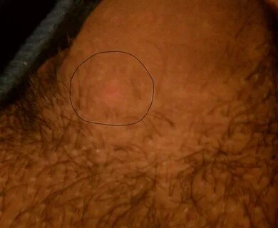 Ingrown Hair Base Of Penis / Ingrown Hair On Penile Shaft Wh