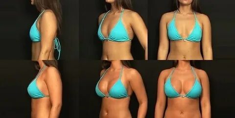 Pictures of the breast augmentation surgery: Before and Afte