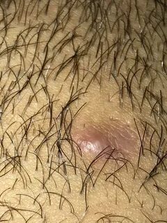How To Remove Hair Bumps From Pubic - Biointerchange