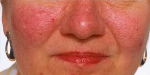 Stanford Medicine 25 on Twitter: "#Rosacea typically occurs 