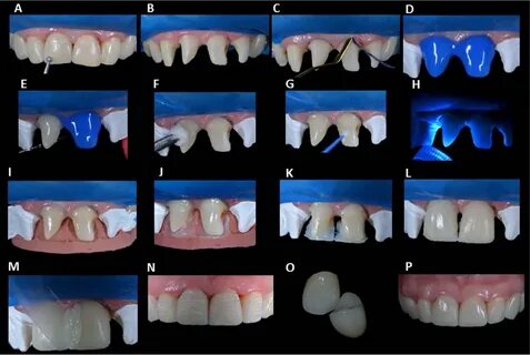 Esthetic smile rehabilitation of anterior teeth by treatment
