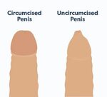 Differences Between A Circumcised Vs. Uncircumcised Penis - 