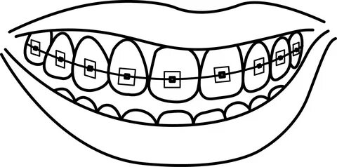 Dental braces Dentistry Human tooth Drawing - tooth cavity p