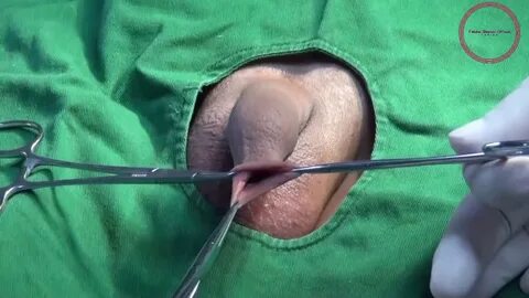 ShangRing - Non-Flip Circumcision Surgery with Topical Anest