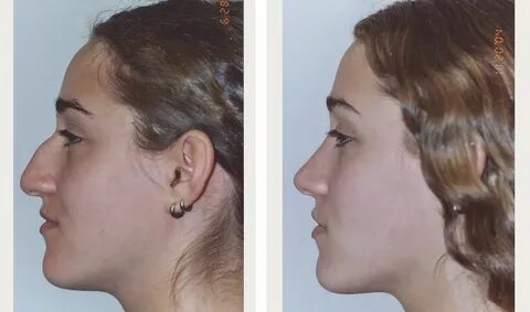 Teen Rhinoplasty NYC - Can a Nose Job Change Your Life?