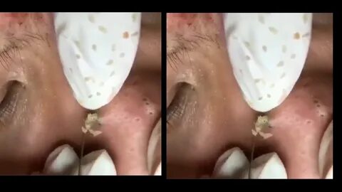 dr pimple popper - YouTube