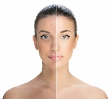 Rejuvenescimento Facial * LCCP Microagulhamento rosto, Clare