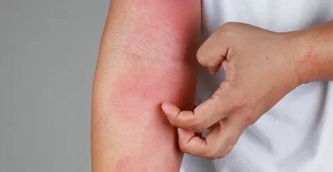 Upadacitinib superior to dupilumab in atopic eczema - Hospit