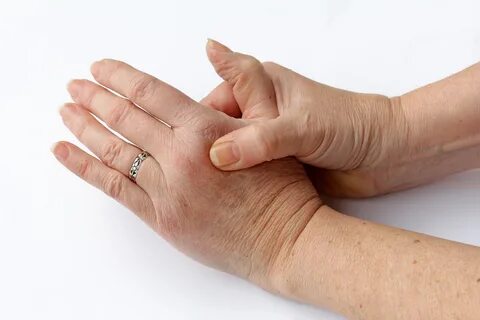 Gesundheit: Verursacht ständiges Fingerknacken wirklich Arth