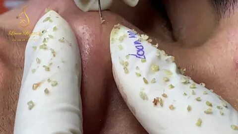 New Blackhead Videos - Video blackheads on woman nose can be