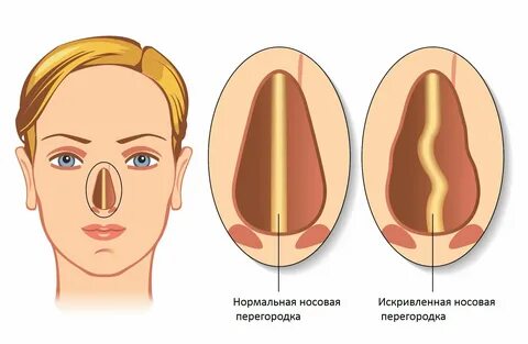 Искривление носовой перегородки 