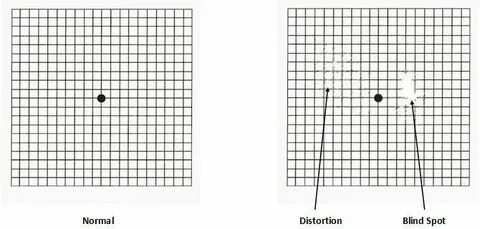 amsler chart distortion - Fomo