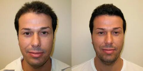 5 Years After Hair Transplant Follow-Up - Dr. Brett Bolton's