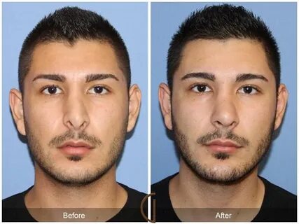 Nose Surgery Before And After Male / Male Rhinoplasty: Befor