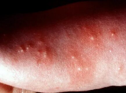 Papular Urticaria - Pictures, Causes, Treatment, Symptoms