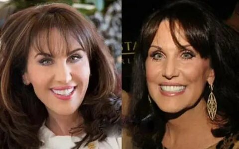 Dr. Phil's Wife Robin McGraw Plastic Surgery - Did She Reall