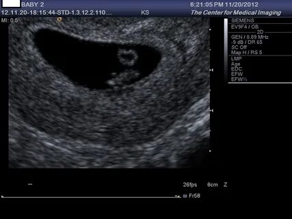 8 Weeks 0 Days Ultrasound Related Keywords & Suggestions - 8