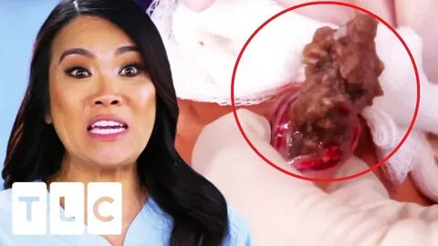Dr. Pimple Popper - "It's Like Ground Beans!