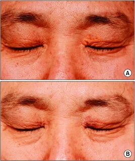 A) Before and (B) one month after Er:YAG laser treatment of 
